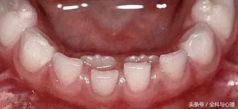 孩子换双排牙,小孩大了双排牙最佳解决方法