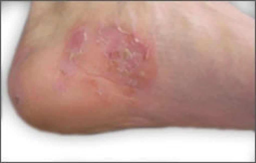 脚气引起皮质增厚怎么用药,脚气用碘伏之后可以用药吗