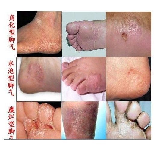 脚气引起皮质增厚怎么用药,脚气用碘伏之后可以用药吗