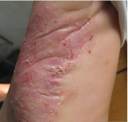 脚气引起皮质增厚怎么用药,脚气用碘伏之后可以用药吗