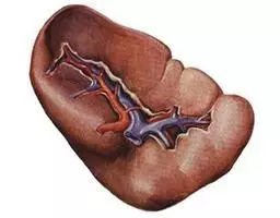 谢别录看血液病怎么样,血小板减少的小红点儿是什么样的