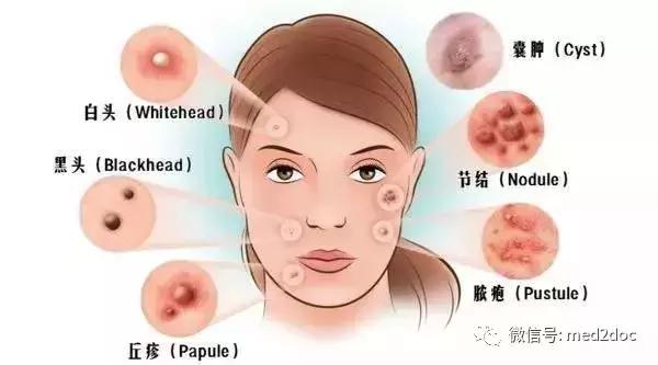 痘痘分几种而且该用什么方法去掉,脸上的痘痘能乱挤吗