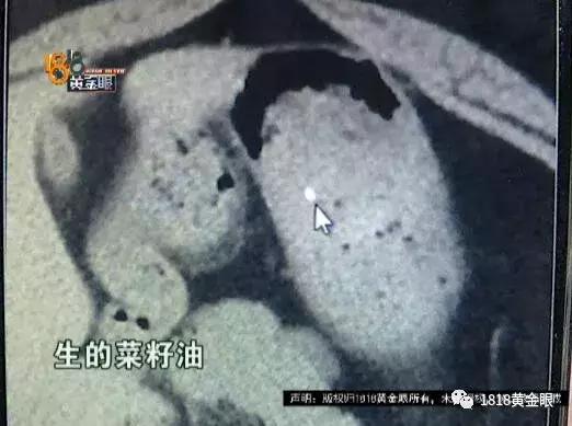 酒店吃出玻璃渣怎么办,在酒店吃饭吃出来块玻璃