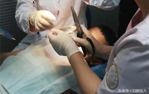 医生给儿童拔门牙,儿童门牙断了做活髓切除