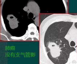胸部ct发现有淋巴结严重吗,胸ct能查出肺结节和肺癌吗