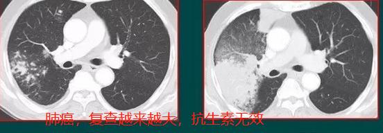 胸部ct发现有淋巴结严重吗,胸ct能查出肺结节和肺癌吗