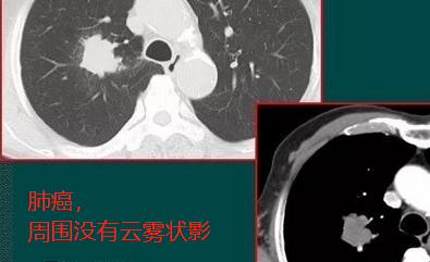 胸部ct发现有淋巴结严重吗,胸ct能查出肺结节和肺癌吗