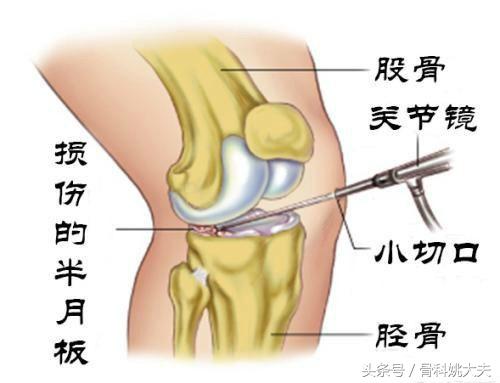 为什么半月板损伤越休息越疼,为什么半月板受伤腿会变细