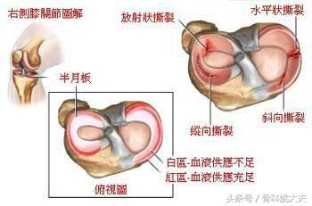 为什么半月板损伤越休息越疼,为什么半月板受伤腿会变细