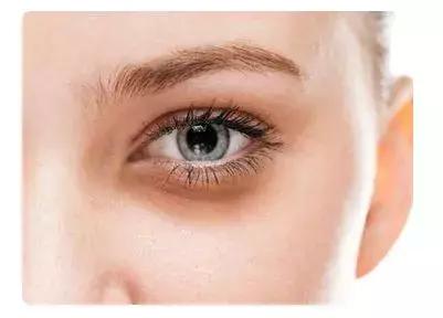 熊猫眼黑眼圈怎么去除最简单方法,祛黑眼圈