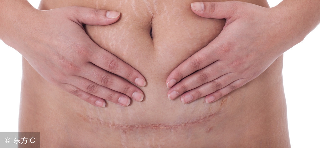 准妈妈剖腹产后别任性，不想刀口变黑，要做到以下3点