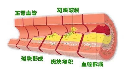 得了冠心病，这两项治疗就要坚持！