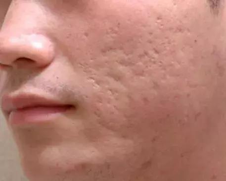 祛痘印干货分享,最全祛痘攻略快速祛痘不留痕