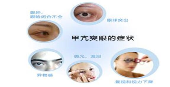 甲亢突眼恢复案例,甲亢突眼了怎么办啊