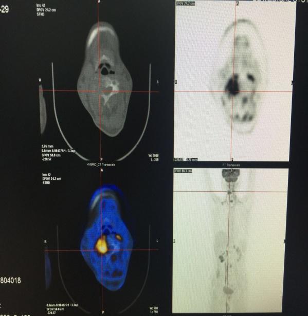 找不到原发病灶是好事吗,petct也做了还没找到原发灶怎么办