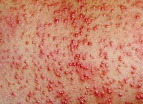 宝宝长痱子哭闹不停,宝宝一哭就起痱子怎么办