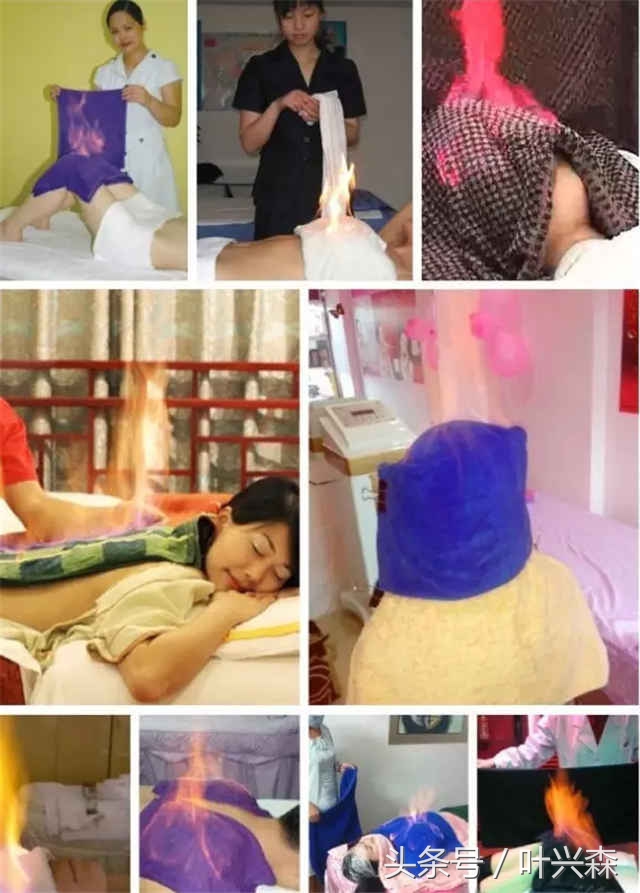 火疗在国外,外国火疗