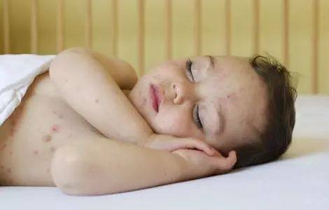 广州哪家医院看儿童湿疹最好,宝宝为什么爱起湿疹