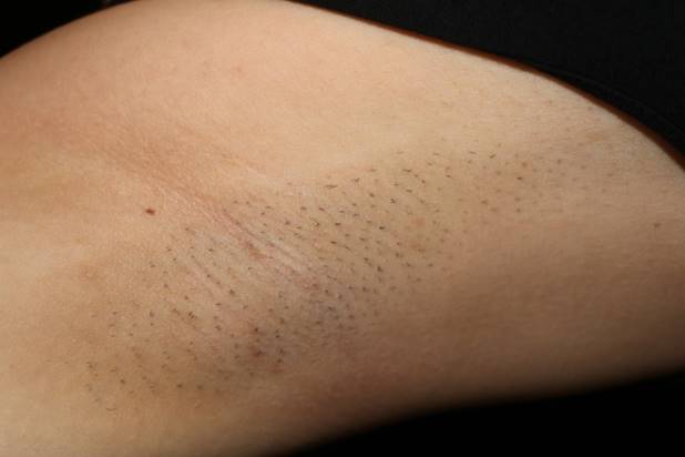 脉冲光去毛,脉冲除胡子