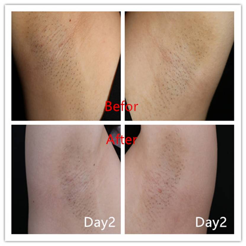 脉冲光去毛,脉冲除胡子