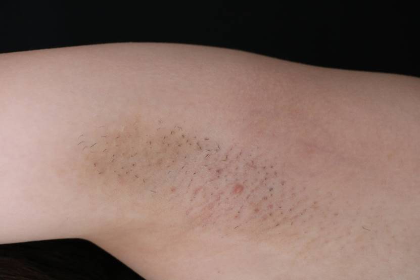 脉冲光去毛,脉冲除胡子