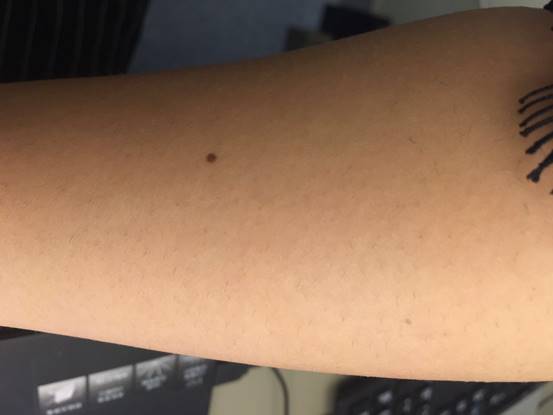 脉冲光去毛,脉冲除胡子