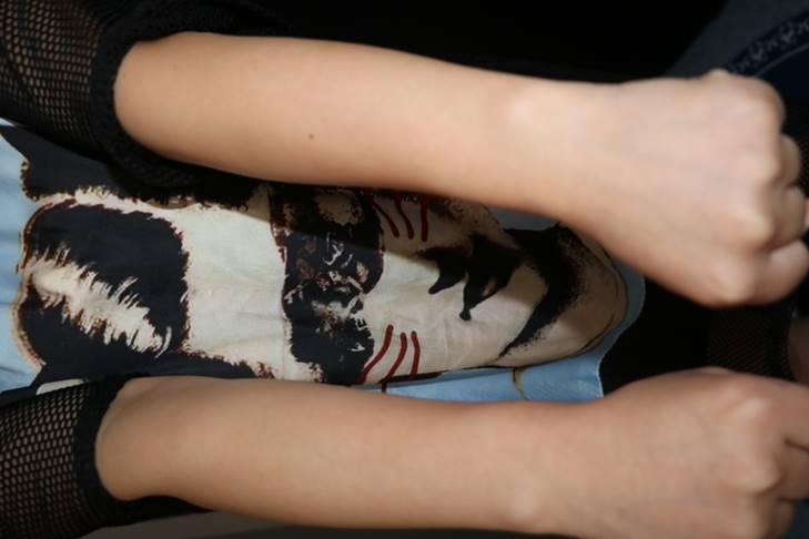 脉冲光去毛,脉冲除胡子