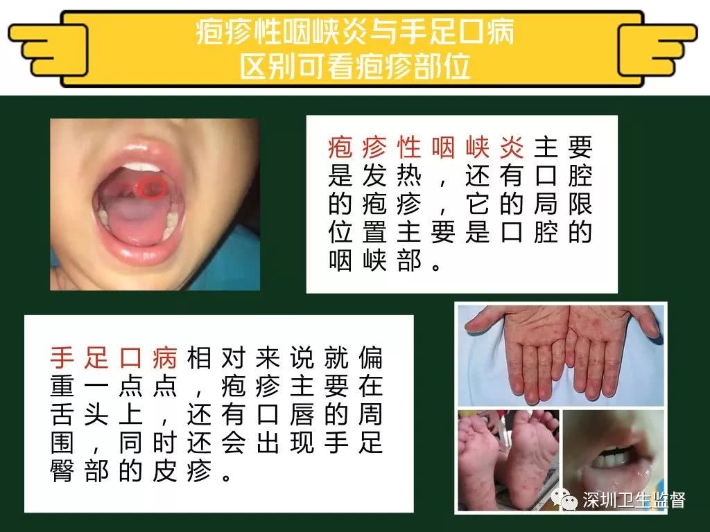 小孩喉咙有疱疹反复发烧是什么病,孩子发热喉咙有痰怎么办