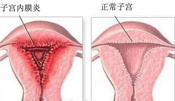 子宫内膜炎会不会病变,子宫内膜回声不均会导致不孕么