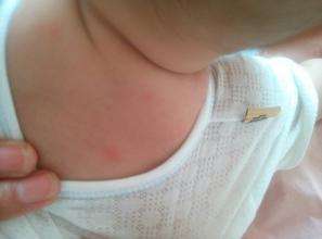 小孩得了麻疹怎么办,宝宝得了荨麻疹怎么治疗最有效