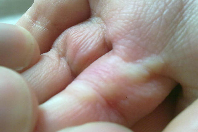 宝宝烫伤以后要注意什么,宝宝被烫伤后应该怎么处理