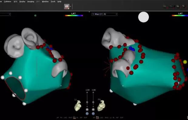 房颤伴窦性停搏怎么治,李广平心脏起搏视频