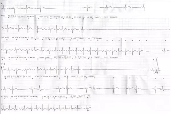房颤伴窦性停搏怎么治,李广平心脏起搏视频