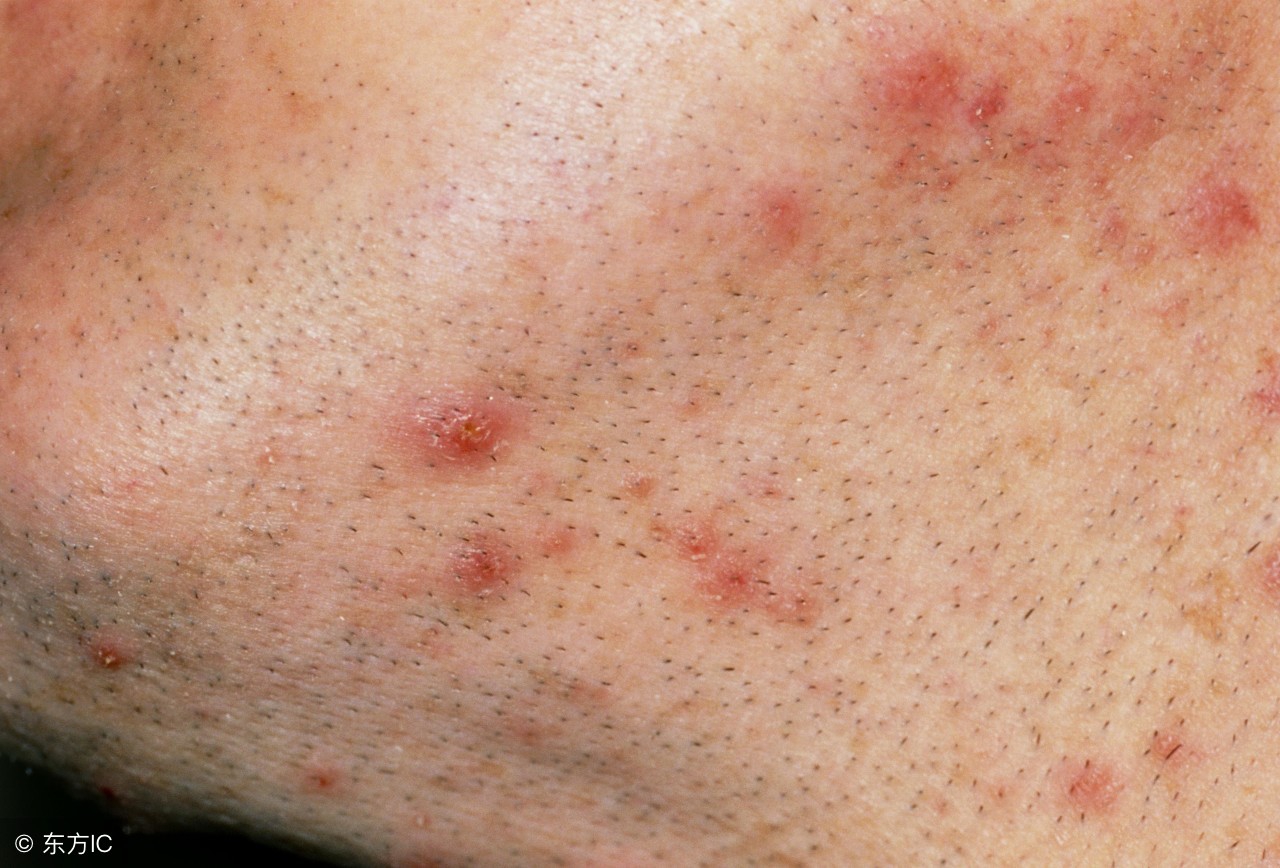 毛囊炎导致的脱发可以治得好吗,秃发性毛囊炎脱发还能长出来吗