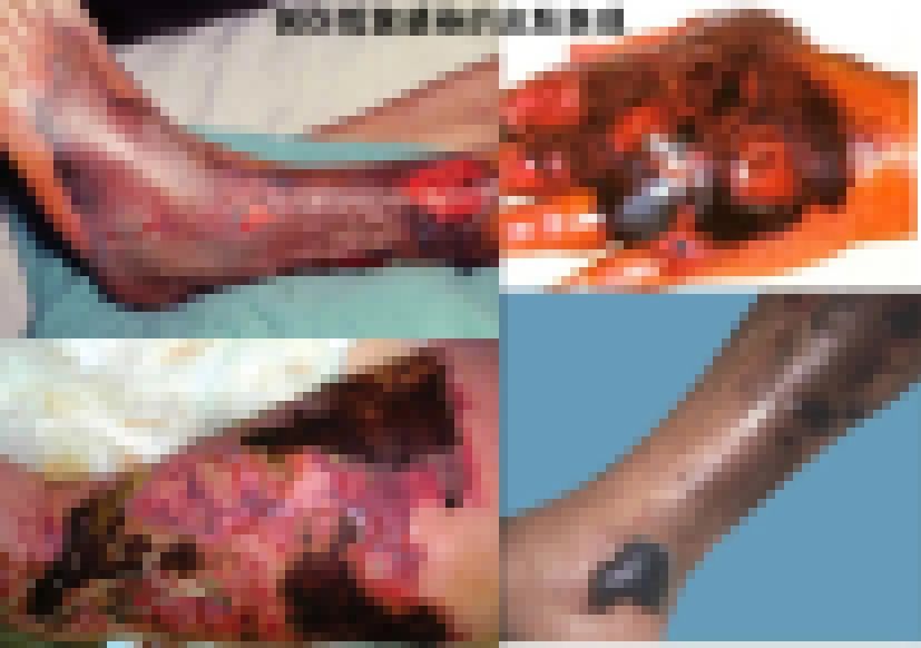 鱼刺戳到手指为什么会感染,被鱼刺扎了会引起感冒吗