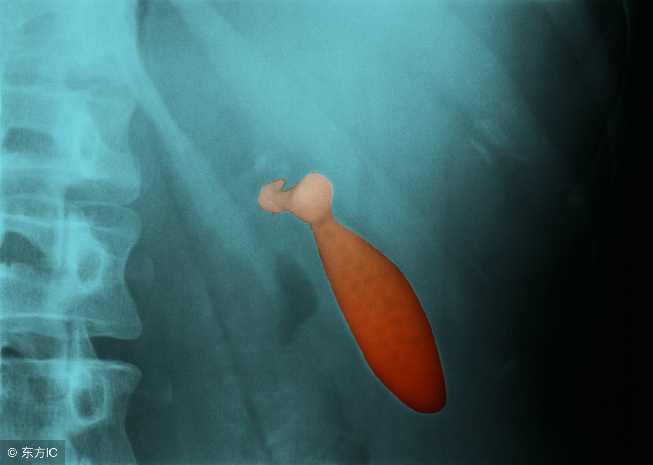 胆结石腹痛是哪个地方痛,胆结石疼痛的症状有哪些