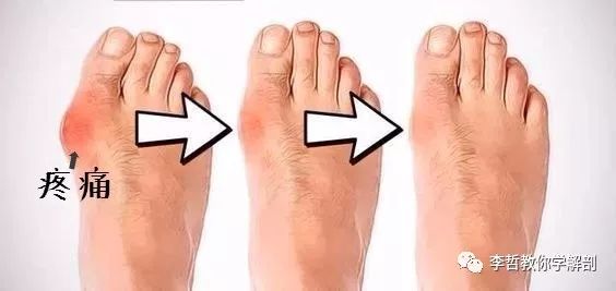 拇外翻该怎么办,拇外翻的解决方法
