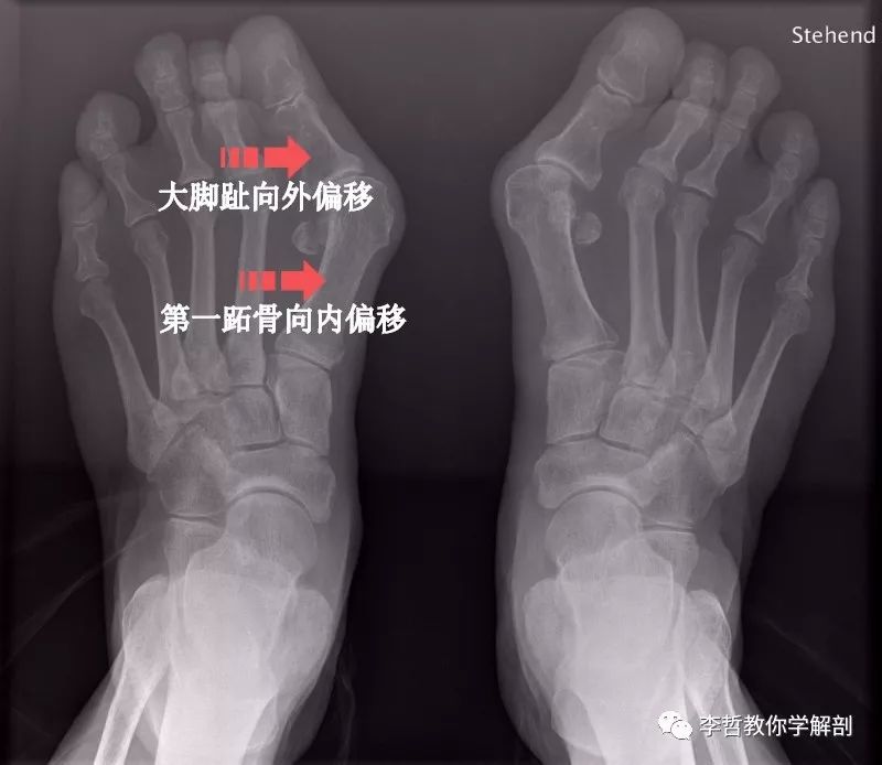 拇外翻该怎么办,拇外翻的解决方法