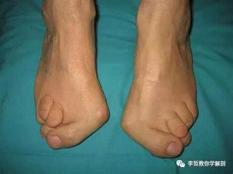 拇外翻该怎么办,拇外翻的解决方法