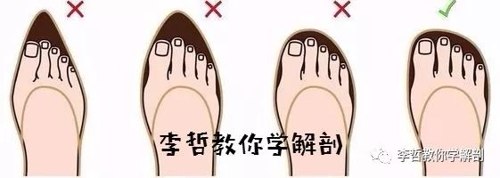 拇外翻该怎么办,拇外翻的解决方法