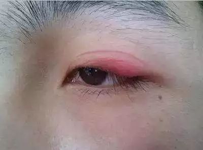 粘得牢又自然的双眼皮贴推荐,石膏板双眼皮用什么粘贴最牢固