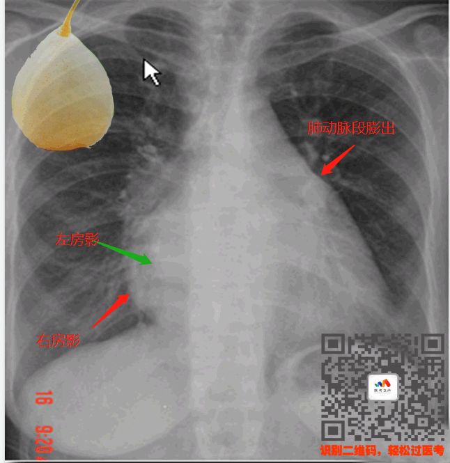 执医技能:X线阅片,全是套路,超简单