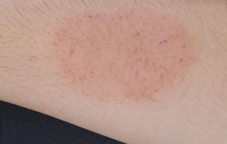 夏季湿疹止痒最有效的方法,湿疹皮肤干燥怎么办小妙招