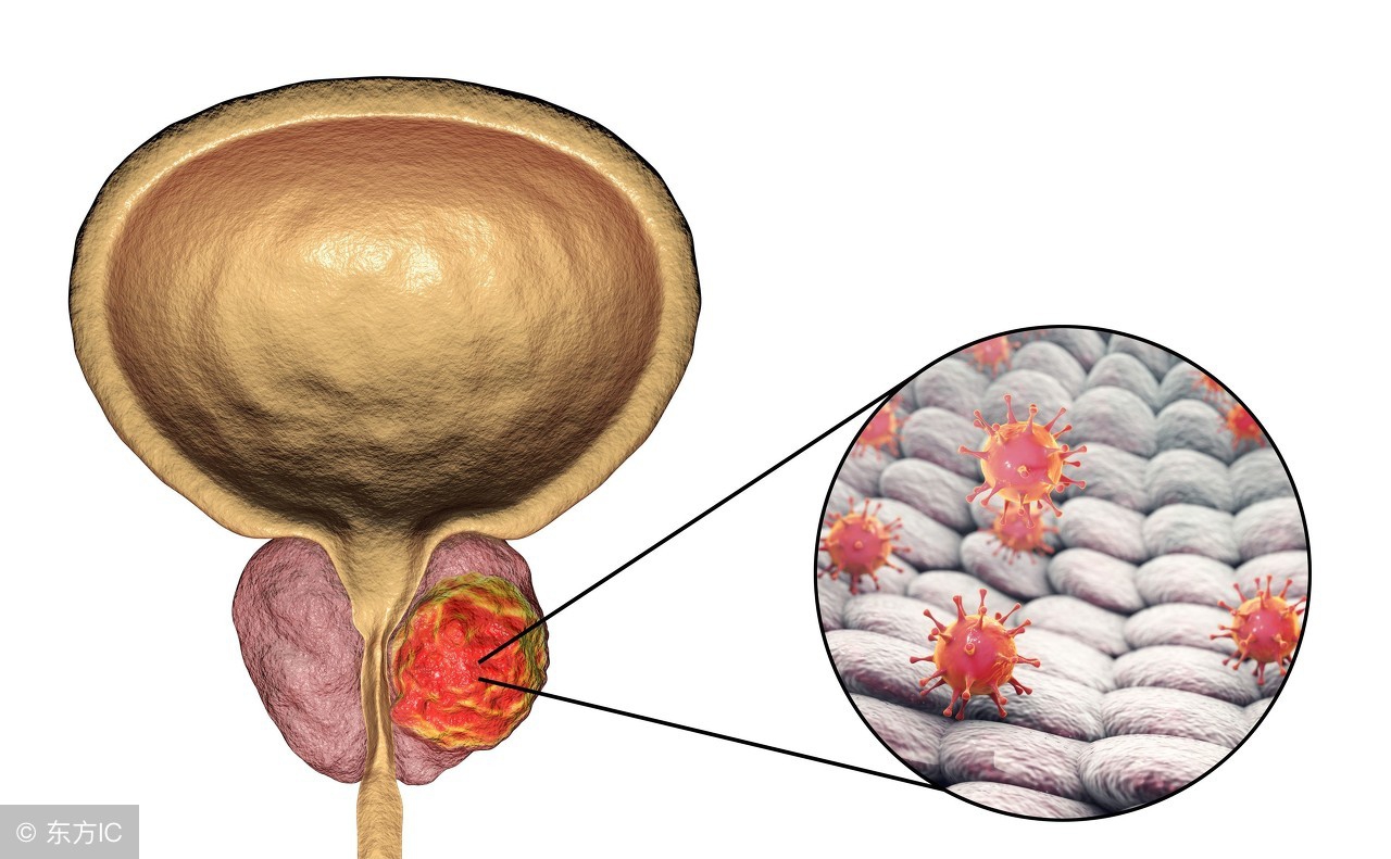 前列腺炎的危害，自测方法，以及治疗小偏方