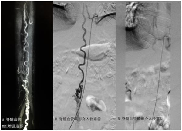 双下肢瘫痪的康复训练之路,突然下肢无力瘫痪