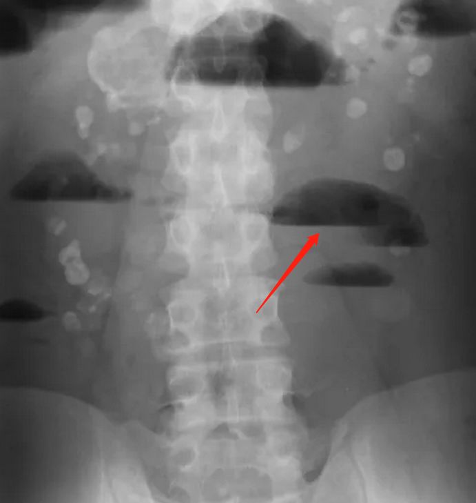 肠梗阻出现液气平严重吗,肠梗阻容易产生什么气体