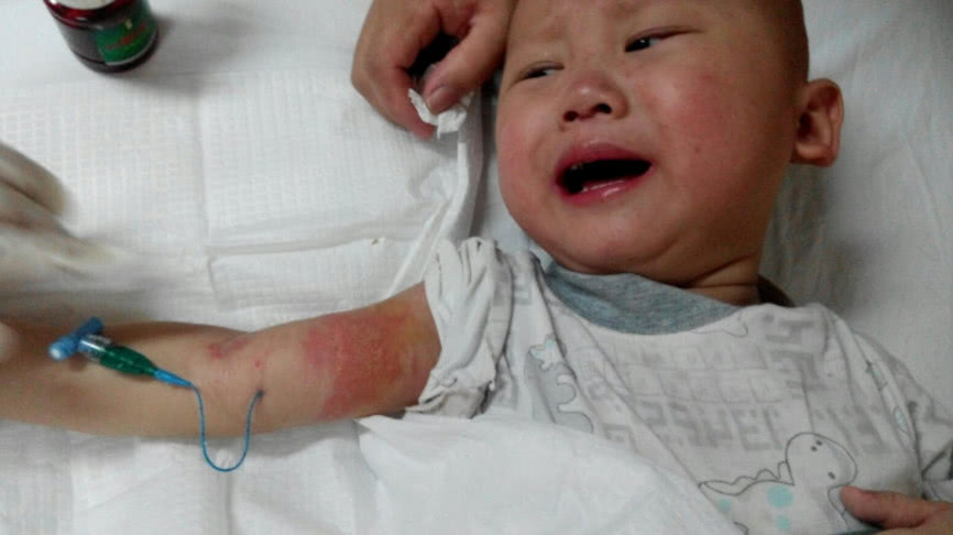 宝宝夏季湿疹最好的解决办法,夏季小孩湿疹的最佳治疗方法