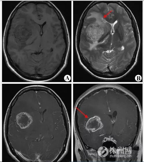 长时间玩手机得脑瘤是真的吗,玩手机会导致脑瘤吗