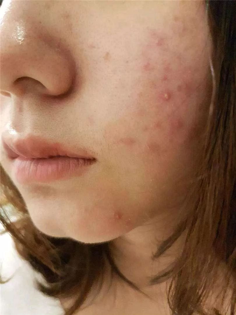 靶向治疗怎么预防副作用,如何防止靶向药伤肾