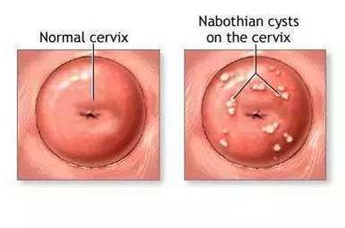 您还在为这3种宫颈的表现而困扰吗？那就太OUT了！